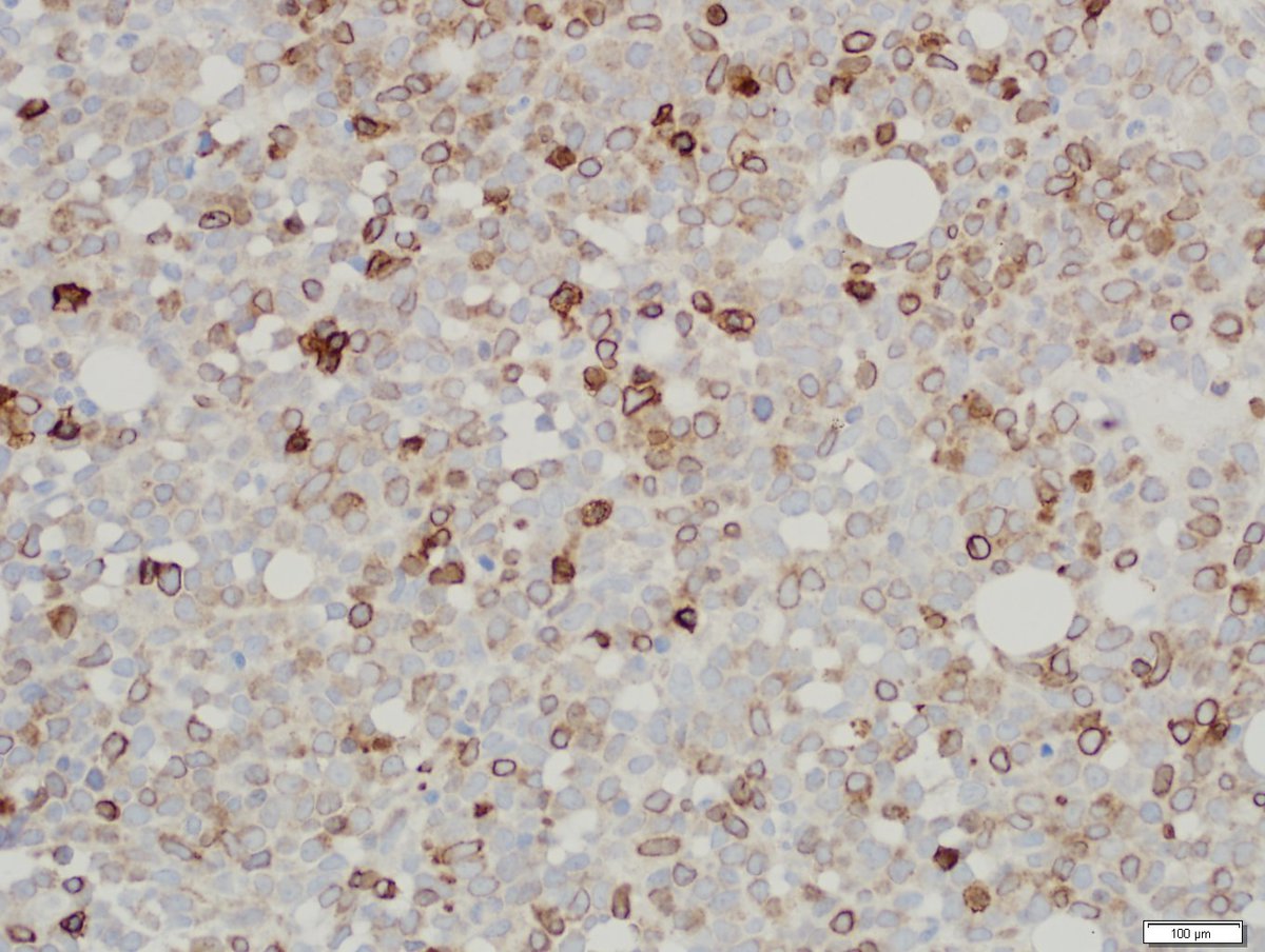 Heterogeneous CD3 expression in the bone marrow